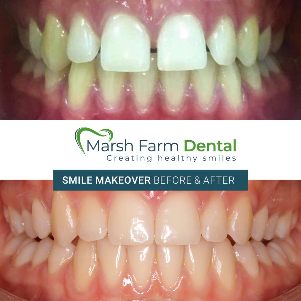 Invisalign at Marsh Farm Dental Marsh Farm
